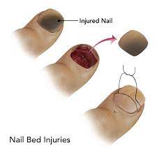 nail bed injuries springfield nail