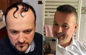The patient, at this phase, will notice a consistency in his hair. Before And After Hair Transplant Step By Step Situation Rephair
