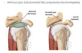 A comprehensive guide to epidural steroid injections: Subacromial Decompression Arthroscopic St George Surgical Center