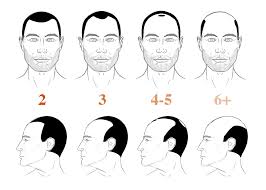Norwood 2 Hairline 3 Ways To Stop It Naturally Before It