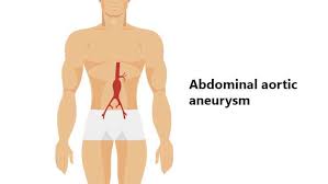 Aneurysms can develop in several parts of your body, including: Abdominal Aortic Aneurysm Causes Symptoms Treatment And Prevention Medlife Blog Health And Wellness Tips