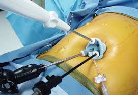 single incision sleeve gastrectomy