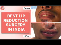 lip reduction treatment with co2 laser