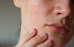 dry skin vs eczema how to tell the
