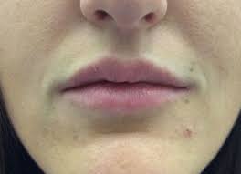 temporary lip fillers overview cost