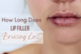 how long does lip filler bruising last