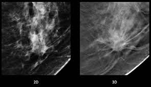 Digital Breast Tomosynthesis Uf Health Radiology Uf Health