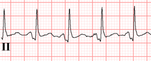 This is suggestive of pericarditis, however 12% of patients with stemi. Pericarditis Ecgpedia