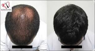 Product reviews, product recommendations, expert tips, top picks Prp For Hair Loss Treatment Costs And Results Prp Finder Com Find Best Platelet Rich Plasma Providers