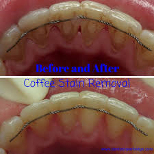 Coffee contains high levels of tannins, or acidic polyphenols, that discolor your teeth. Before And After A Cleaning To Remove Coffee And Tea Stains Parkridgedentist Dentalhygienist Beforean Coffee Stain Removal Wholesale Coffee Coffee Staining
