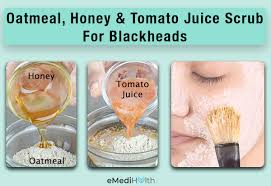 how to get rid of blackheads at home