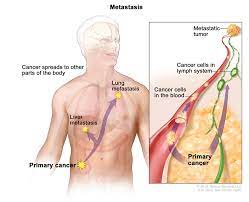 If your cancer spreads, or metastasizes, you may notice signs or symptoms in different parts of your body. Metastatic Cancer When Cancer Spreads National Cancer Institute