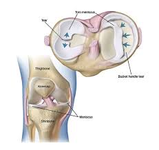 meniscus tear signs causes