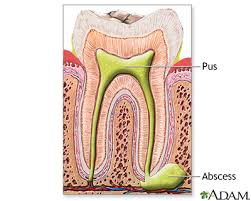 tooth abscess information mount sinai