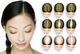 baldness hair loss cure and treatment