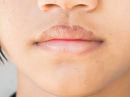 how to get rid of chapped lips 6 ways