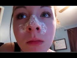 at home remedy to remove blackheads