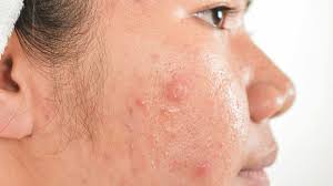 acne scars treatment removal best