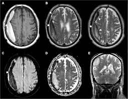 They can be caused by injury to bridging veins or the middle. The Relationship Between Hematoma And Pachymeninges In An Interdural Hematoma Diagnosis And Surgical Strategy Sciencedirect