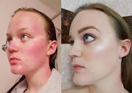 sunburn with makeup