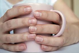 7 causes of white nail spots and when