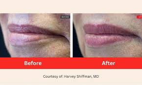 lip plumping laser therapy in san go