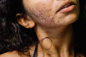 how to prevent acne scars and scarring