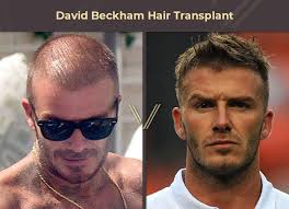 celebrities with hair transplants 40