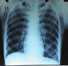 Maybe you would like to learn more about one of these? Chest Radiographs A Apicolordotic View Revealed Fibrotic Infiltrates Download Scientific Diagram