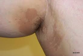 An infected hair follicle is also known as folliculitis. 9 Common Bacterial Skin Infections