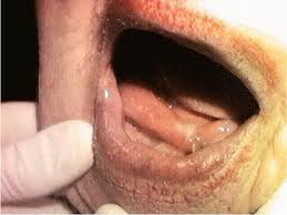floor of mouth abscess ludwig s angina