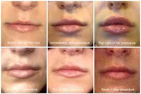 what are the ses of lip filler swelling