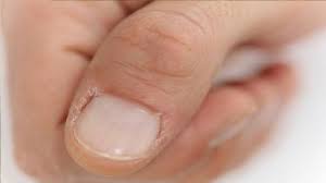 ling skin around nails