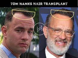 celebrity hair transplant in the world