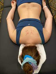 dry needling spinal manition to