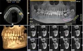 Image result for cbct dental