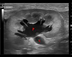 ultrasonography of the kidneys imv