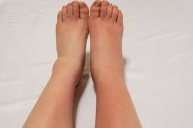 prolonged swelling in the legs