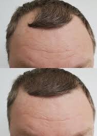 hair transplants the options the