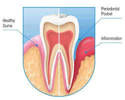periodontal disease flashcards quizlet