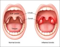 home remes for recur tonsillitis