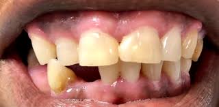 Here is some more information to help further answer this question. Dental Implant Cost Prices In Manchester Windsor Ct Just 3 999