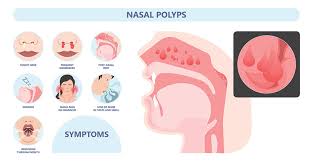 nasal polyps houston nasal polyp
