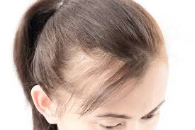 Avoid pulling hair too tight, and do not keep it tied in rubber bands or other holders for long amounts of time. What To Do About Thinning Hair Blog Keranique