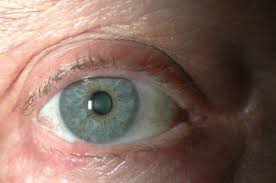 papillomas eyelid springerlink