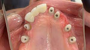 implant dentar cluj ortho implant center