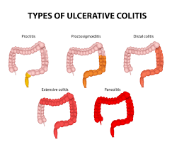 Ulcerative Colitis Genetics Home Reference Nih