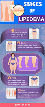 6 health benefits of lipedema t