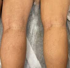 minimize skin graft scars in nyc