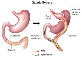 what is gastric byp surgery meaning
